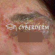 Impetigo contagiosa_Crusta (Kruste)