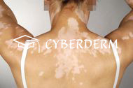 Vitiligo