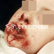 Stevens-Johnson Syndrom (SJS)