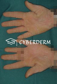 Dermatophytosen